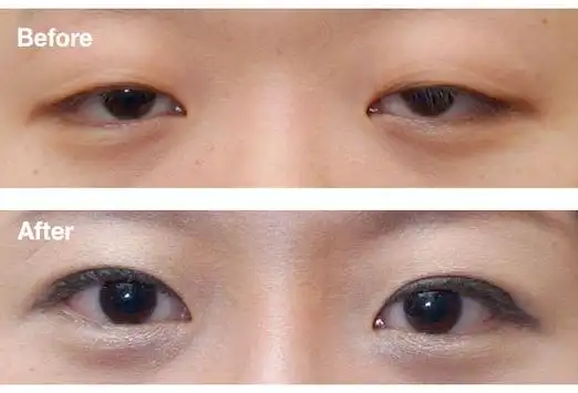 有的小孩在刚出生时候就有先天性的上眼睑下垂,但是由于年龄太小,症状