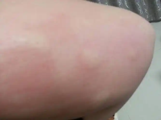 一个小蚊子,一下子咬了这么多包,五个了!为什么会这样