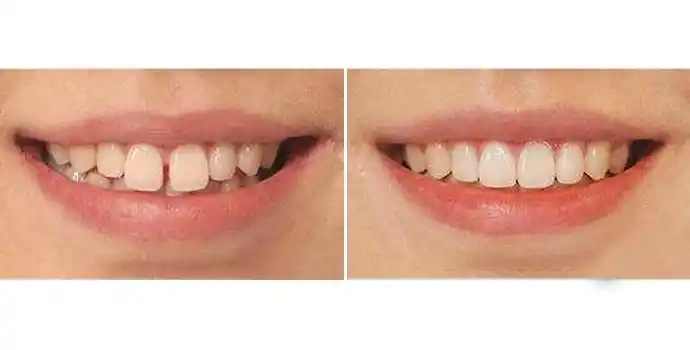 牙齿贴面-树脂贴面效果图,案例前后对比照片