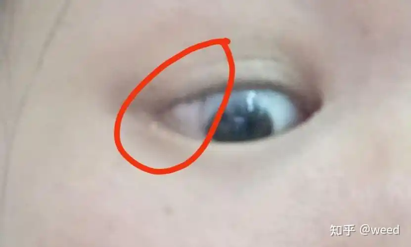 我的皮样脂肪瘤是长在左眼,它像一块没用的肉,覆盖在眼睛里,眼角可以