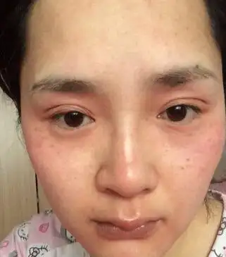 避免吃咸水鱼,虾,蟹等易引起过敏的食物,对于油腻,冰冷,油炸,腌卤等也