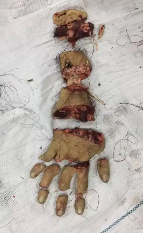 手臂被截断6段9节,断肢再植,全部存活!