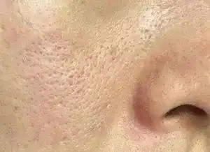 兰蓉锦囊毛孔粗大多半是好不了不看这里