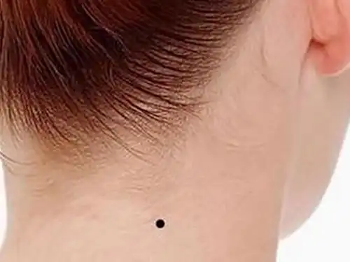 脖子有痣的命运如何