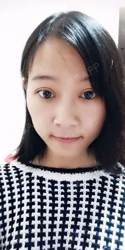 wiyia切开双眼皮第20天美丽日记