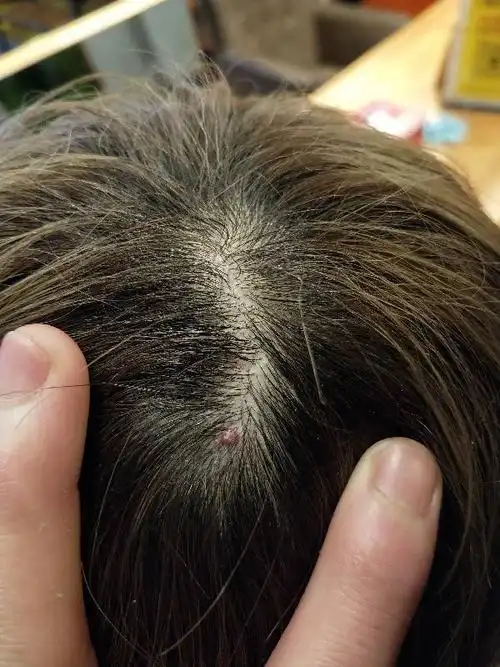 头皮上长了一个小红疙瘩是什么,有什么影响吗.怎么可以让它消失