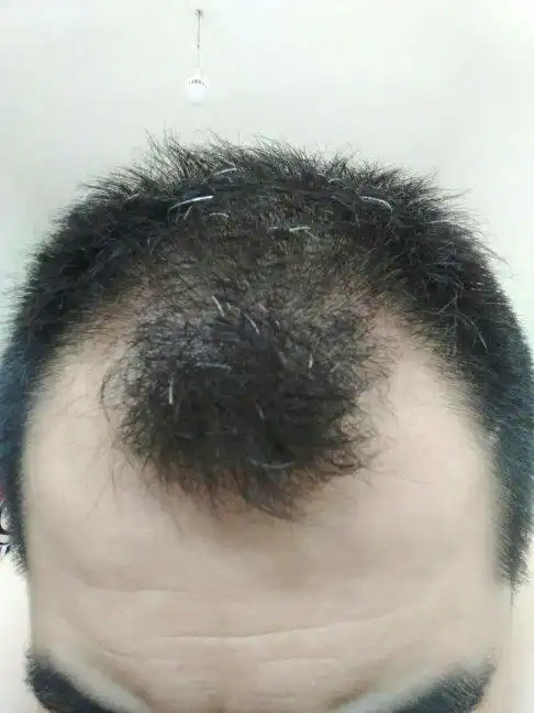 断断续续掉头发已经有5,6年了吧.