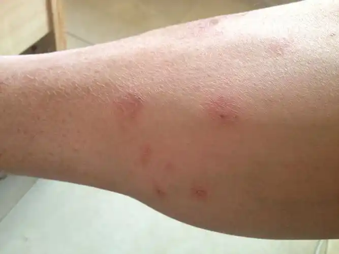 谁知道腿上张这个红斑是咋回事?谢谢!