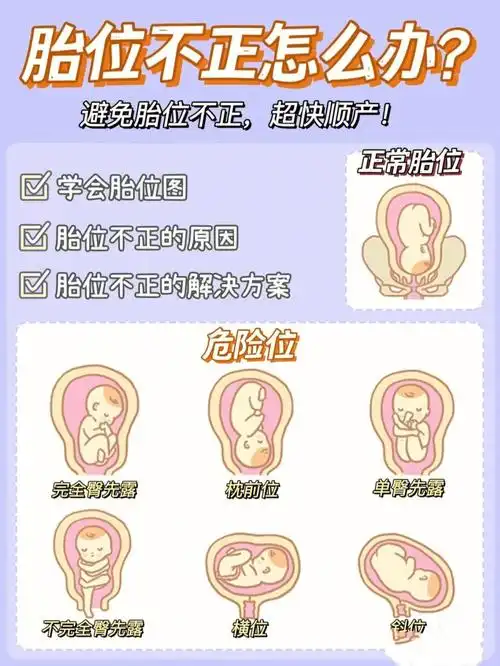 什么是胎位不正胎位不正怎么