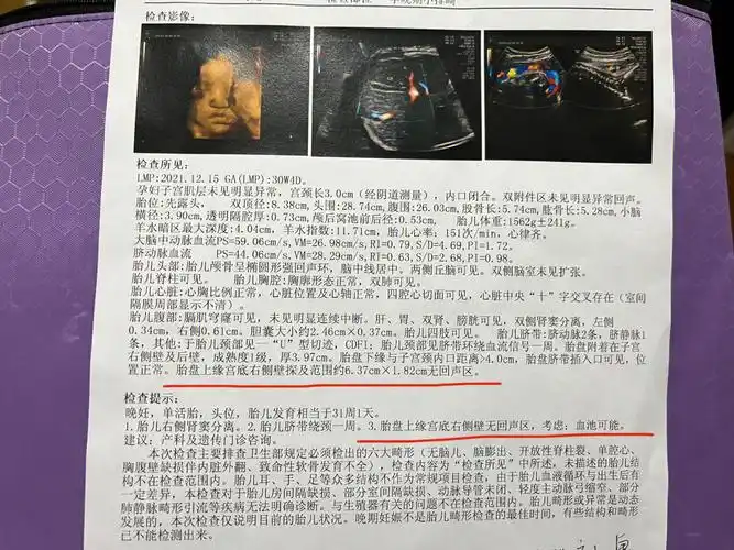 胎盘血池胎盘血窦会有大出血的概率