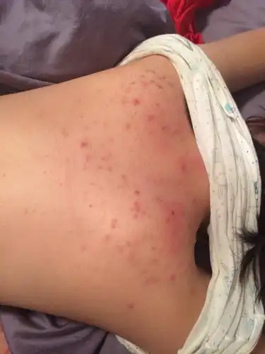 背上长痘痘怎么办.