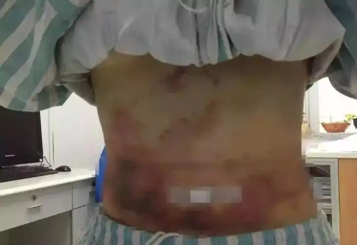 如果不予以及时治疗,不仅会影响日常生活,还很有可能发展为坏死性感染