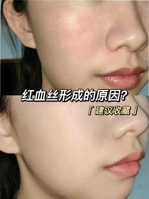 红血丝的原因
