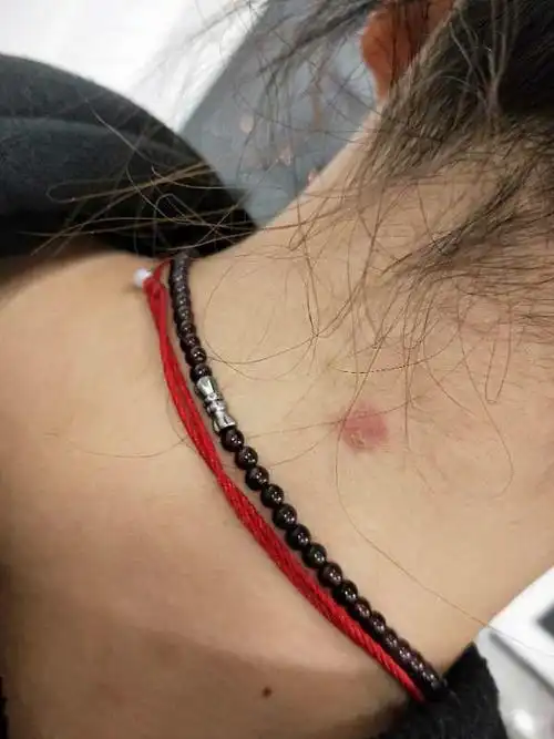 我脖子后面有一块红斑有点痒朋友说表面都是小疙瘩很久了