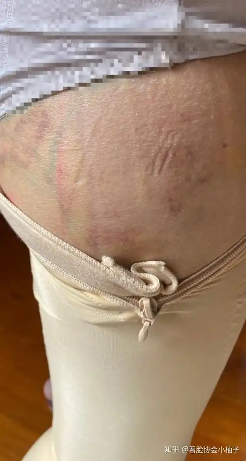 大腿吸脂恢复记录,详细记录了我的伤口吸脂术后恢复,慎入,价格:28000