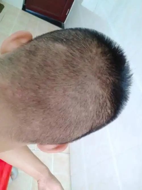 后脑勺长了好多大疙瘩,又痒又硬