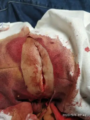 其它 五一假期去哪里? 写美篇一直想建议住院,去手术室.