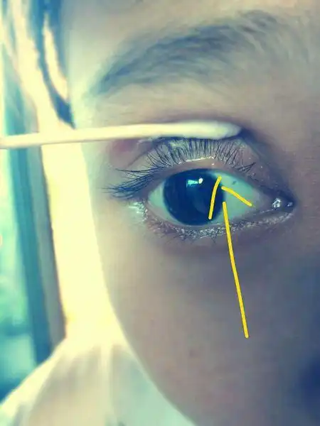 本宝宝眼皮里长了一个奇怪的小疙瘩 不痛不痒的,要