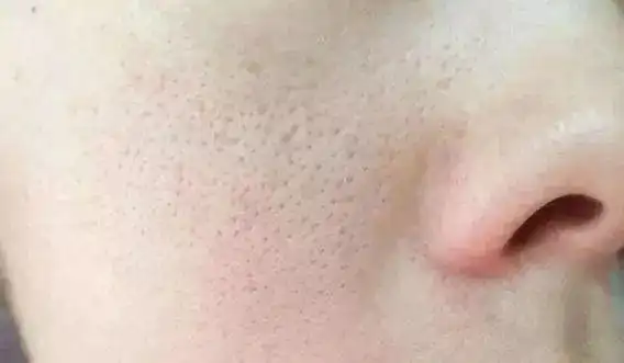 教你3招来拯救你的毛孔