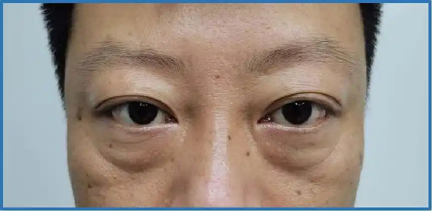 《对手》中的郭京飞,对于祛眼袋的见解亮了