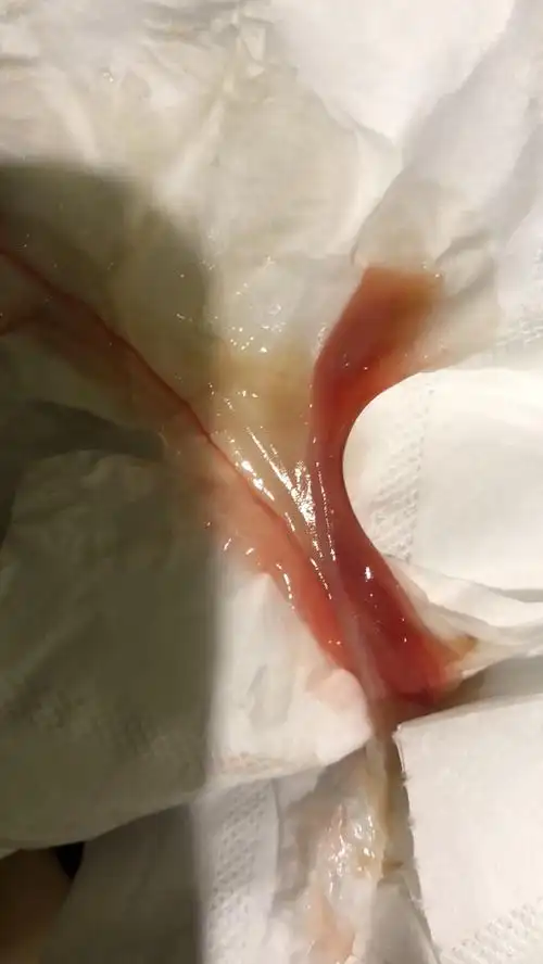 白带里突然有这样子的红血丝,可是我还是处女呀