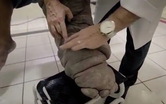 巴西男子患象皮病 腿部肿胀似象腿(组图)