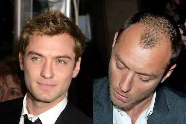 不止贝克汉姆难逃大不列颠"脱发基因" 这些明星也一样