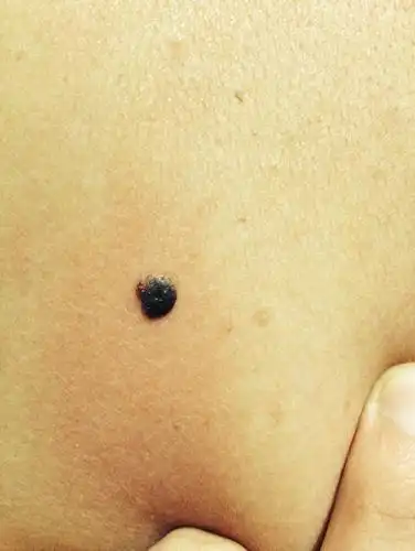 我妈后背上的.问大家这是痦子么?不是电影里的黑色素瘤吧?好担心.