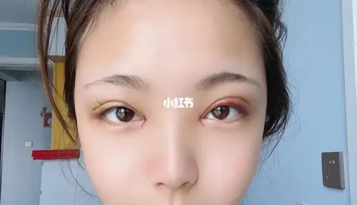 埋线双眼皮 开眼角的7天记录_开眼角_埋线双眼皮_单眼皮_化妆_美颜