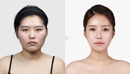 全脸自体脂肪填充后,表情会不自然吗?