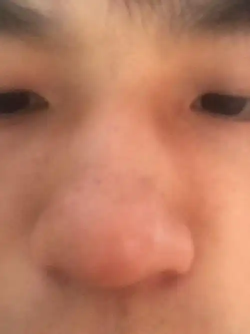 鼻子上有白印,黑头,鼻子还有点黑,脸色还不怎么好,怎么办,用什么方法