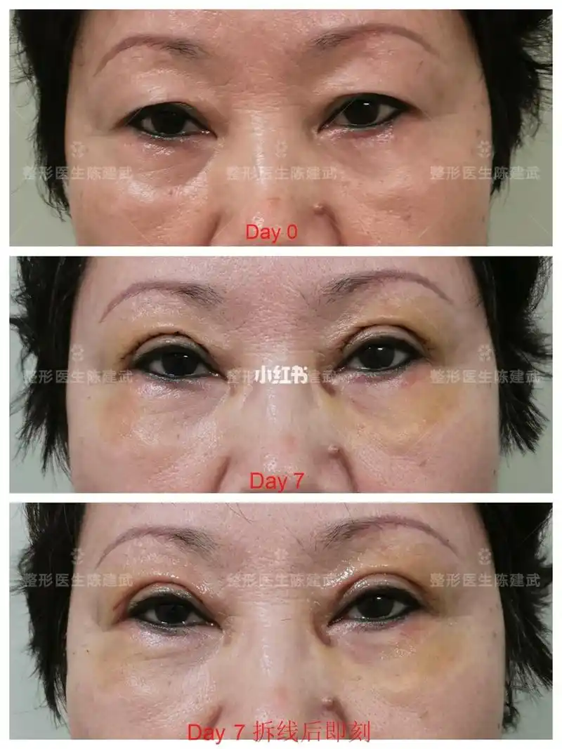 老年双眼皮拆线前后对比图