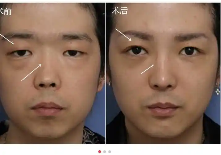 男生割双眼皮对比