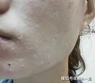 秋冬换季面部干燥脱皮怎么办?_皮肤