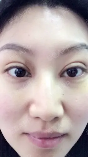 新氧- misslin | 眼部 | 开眼角 | 双眼皮 | 开内眼角 | 埋线双眼皮