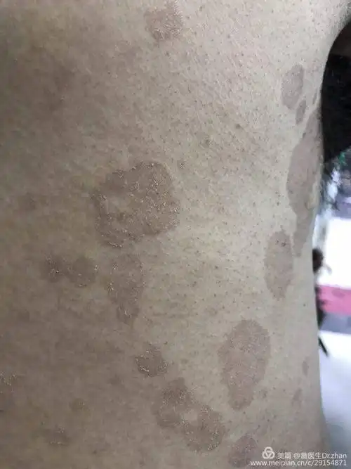 花斑癣,俗称汗斑.