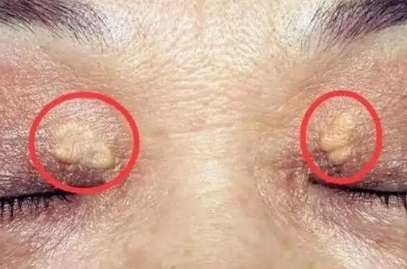 1:睑黄疣血脂异常看身体变化能知道,出现以下症状,最好及时检查一下