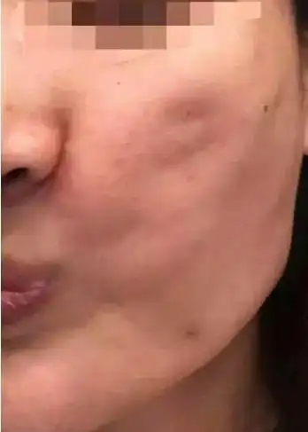 维纳斯脂肪雕刻,面部脂肪填充后凹凸不平,好处理吗