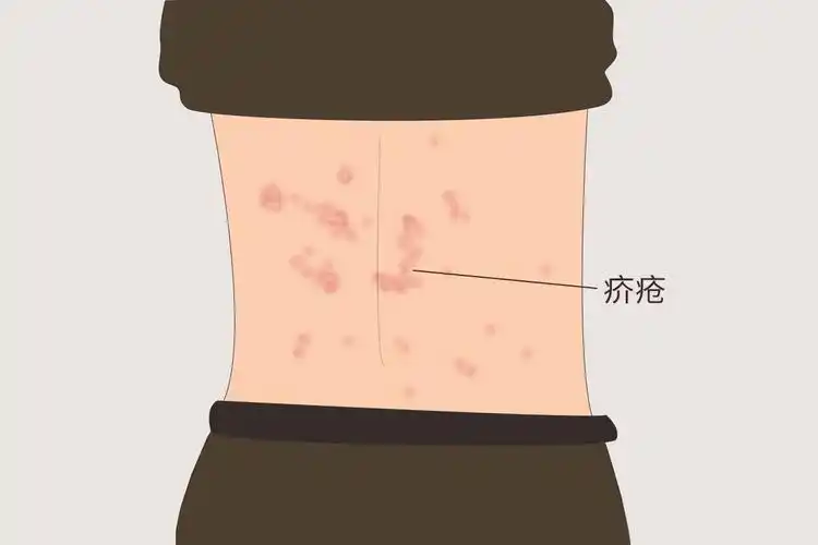 疥疮长什么样子图片