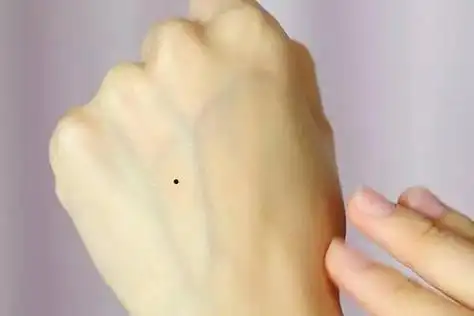 女人右手背有5颗痣图解女人手背都有什么含义