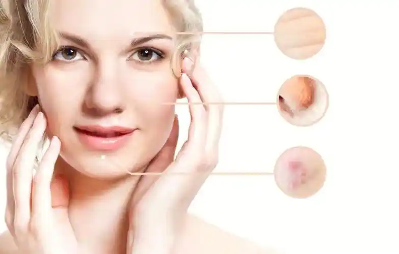 如何保护痘痘肌的皮肤