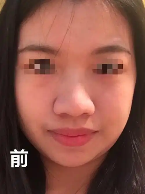 感觉我这个鼻翼缩小做的还是挺成功的,原来鼻翼肥大,_圈子-新氧美容