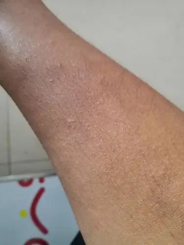 请问我这胳膊上是不是有皮肤病?