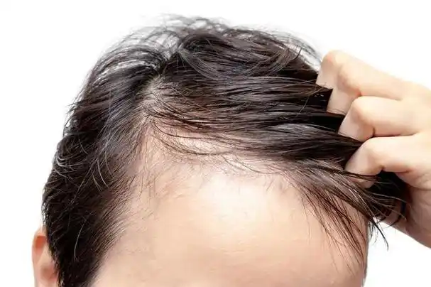 油头星人,学会这4招,轻松解决头发出油问题