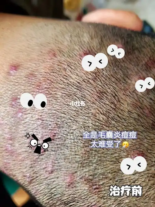 太狠了祛毛囊炎小能手被问了800遍的方