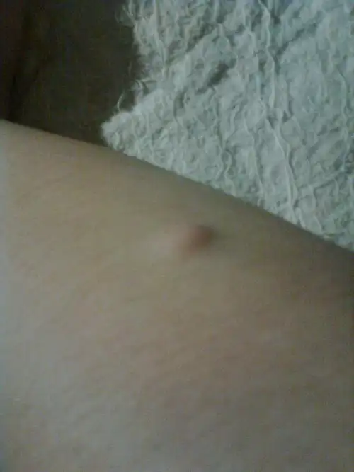 手臂上长了一个小肉瘤一样的东西,不痛不痒,但按上去很硬的感觉,这是