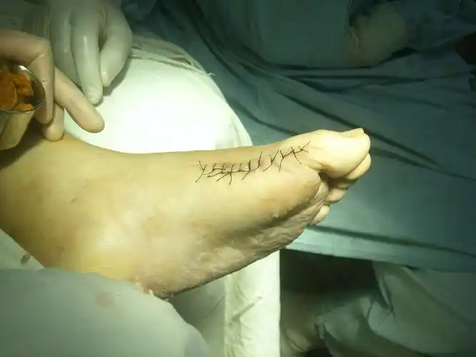 痛风结石清理手术 梁志军