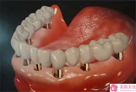 上饶市韩系进口种植牙医院上榜名单哪家有实力上饶市韩系进口种植牙