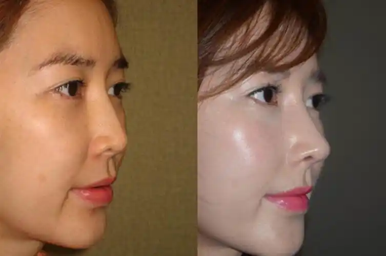 面脂肪填充医院中爱婷家vs可安美案例效果不得不看