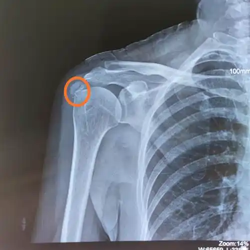 写美篇这是病人在医院拍的右肩关节x线片,相信好多人看不明白是怎么